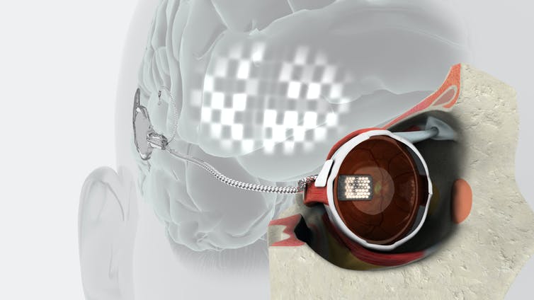 El implante de retina consta de microelectrodos en el ojo. Una cámara de video externa montada en anteojos captura imágenes que se envían a los microelectrodos a través de un estimulador implantable (que se muestra aquí arriba de la oreja). Bionics Institute, proporcionado por el autor (sin reutilización)