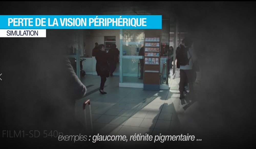 Ejemplo de alteración del campo visual periférico correspondiente a la visión de una persona con glaucoma o retinitis pigmentosa.