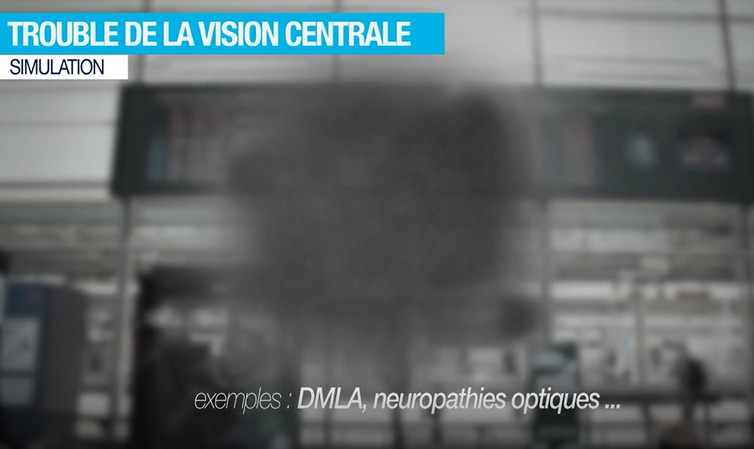 Ejemplo de alteración del campo visual central correspondiente a la visión de una persona con DMAE, neuropatía óptica hereditaria o distrofia de conos